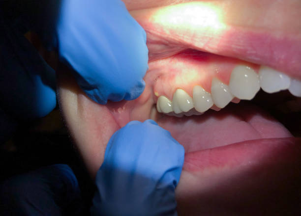 Best Lost Filling or Crown Replacement in Arp, TX